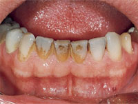 Before cleaning with Prophyflex