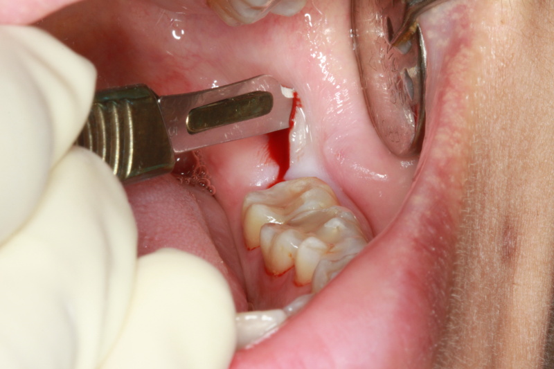 Fig 3 : Incision made to expose the wisdom tooth