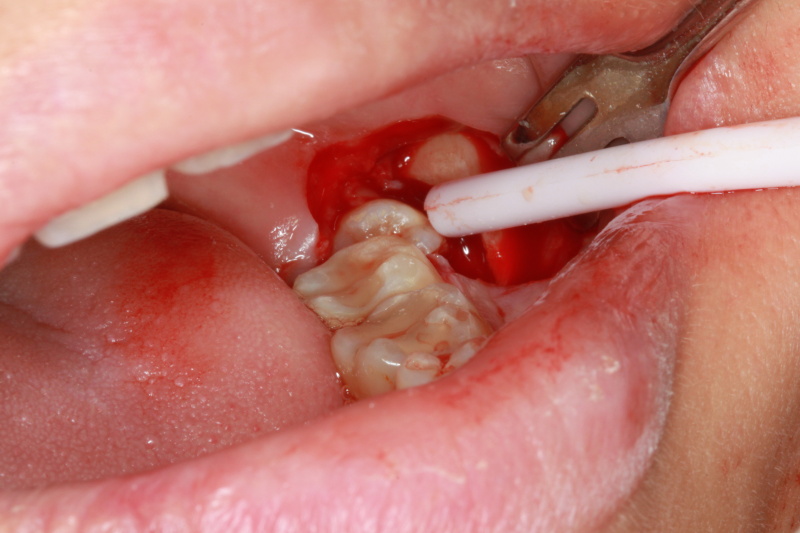 Fig 4 : Impacted wisdom tooth exposed 