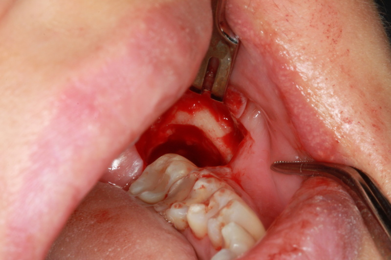Fig 5 : Wisdom tooth successfully removed from the socket