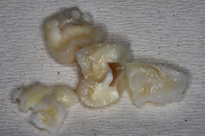 Fig 7 : Wisdom tooth fragments