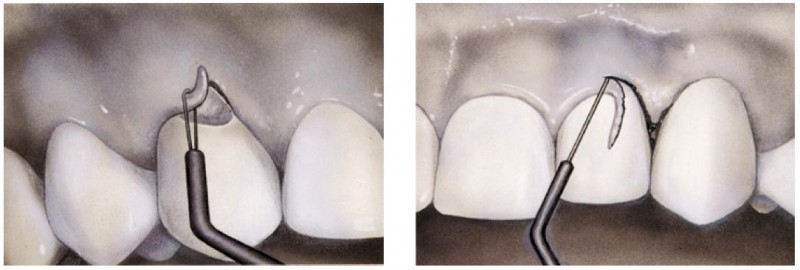 Crown lengthening procedure utilising electrosurgery