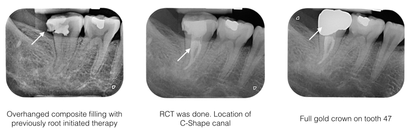 RCT Case 3