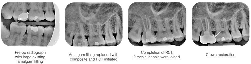 RCT Case 4