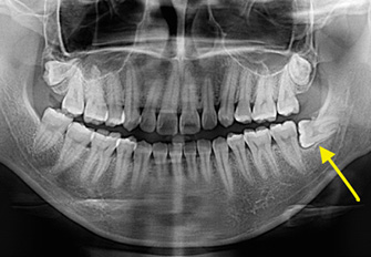 Fig 1 : Pre-operation x-ray shows impacted wisdom tooth