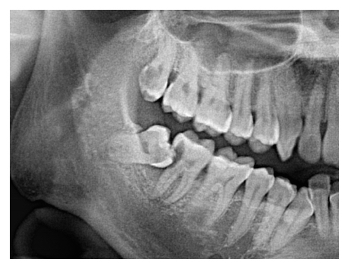 Wisdom Tooth Removal