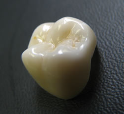 Porcelain bonded to zirconia crown