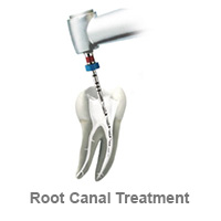 Root Canal Treatment